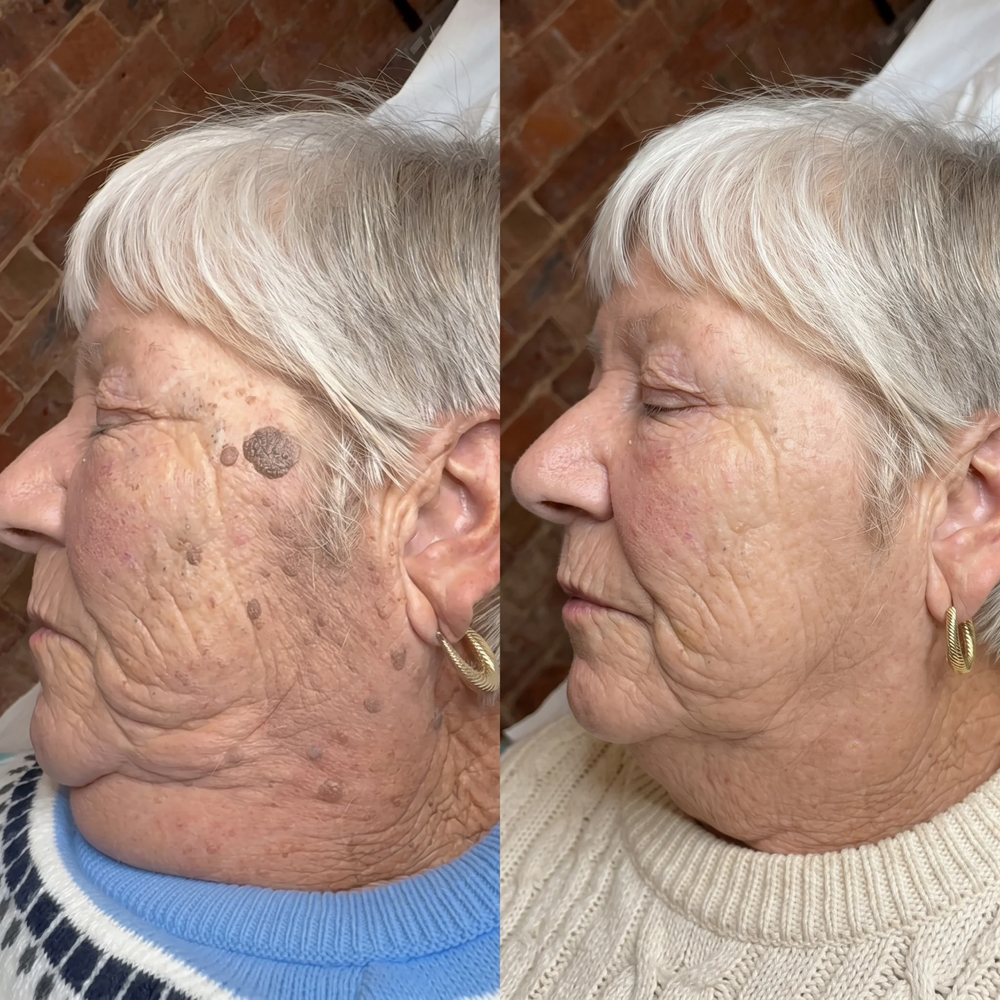 🔥7-day-skin-restoration-serum-pen