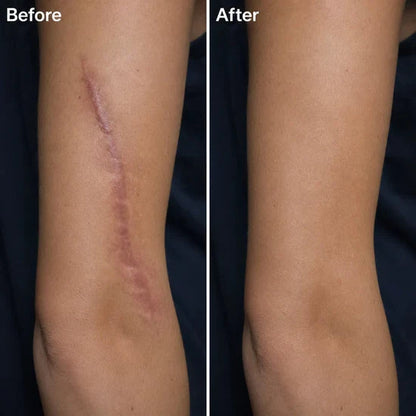 scar-removal-gel