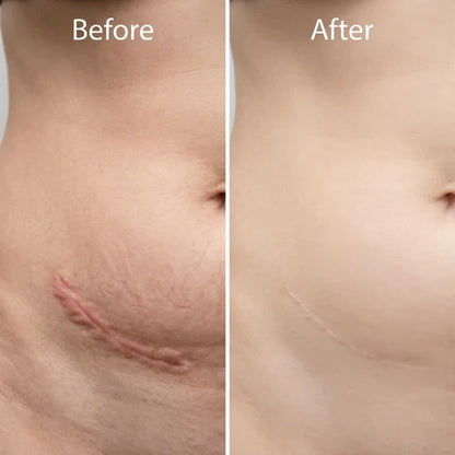 scar-removal-gel