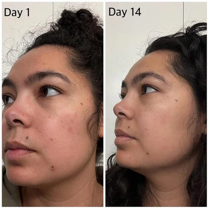 scar-removal-gel